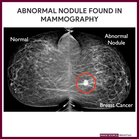 Mammogram Shows Abnormality