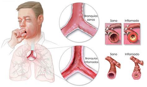 Conoces Los S Ntomas De La Bronquitis Cl Nica Uros