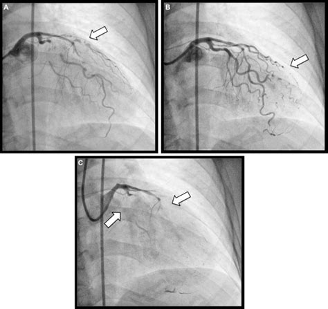 Multiple Air Embolism During Coronary Angiography How Do We Deal With
