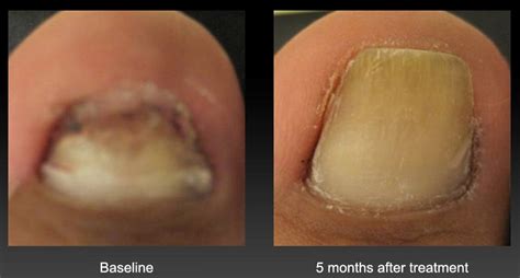 Complete Guide To Toenail Fungus Treatment And Prevention