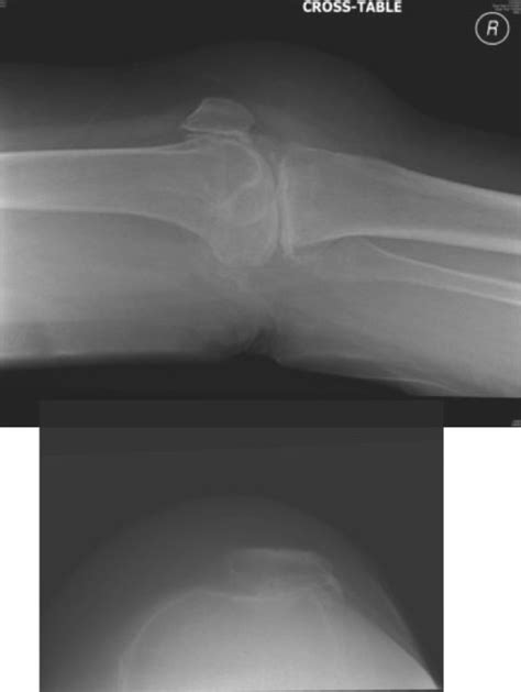 Preoperative Lateral X Ray Of The Right Knee And Skyline Of The
