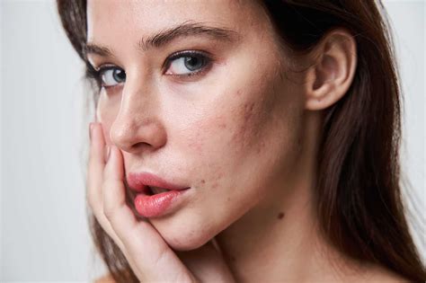 How To Prevent Acne Scars Causes And Treatments Pandia Health
