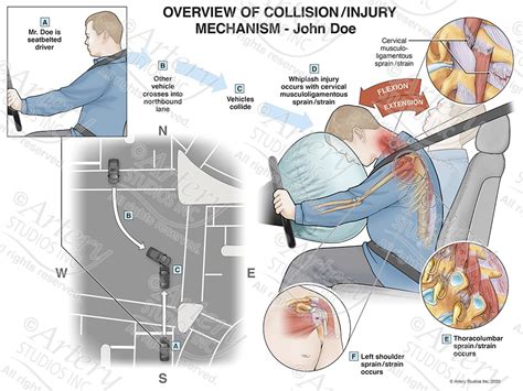 Motor Vehicle Accident Artery Studios Medical Legal Visuals