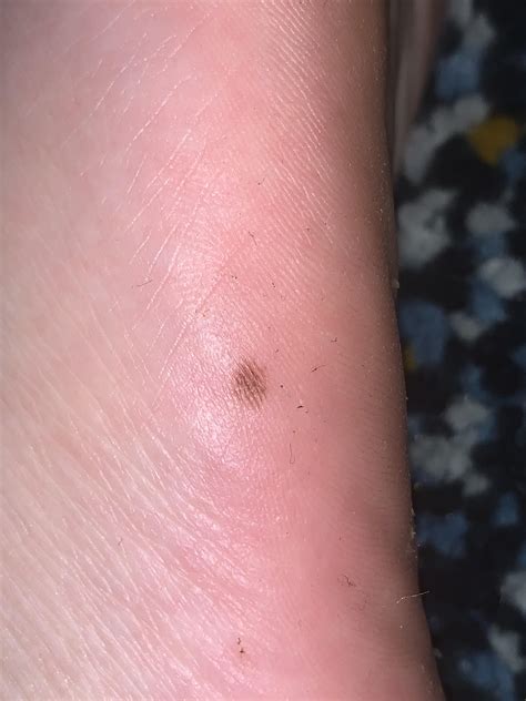 New Mole On Side Of Foot Skin Check Next Week Should I Be Worrying