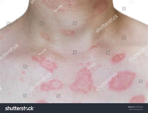 Isolate Ill Allergy Rash Dermatitis Eczema Stock Photo Edit Now