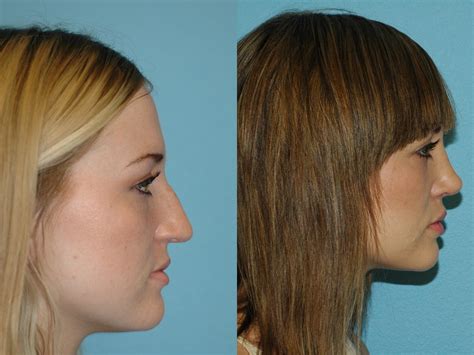 Nose Surgery Before And After Photos Patient 75 San Francisco Ca