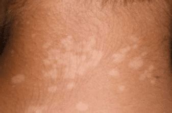 White patches on skin may cause some alarm, if only because they typically appear very suddenly and unexpectedly. White Spots on Skin from Sun, Small, Dots, Causes, Fungus ...