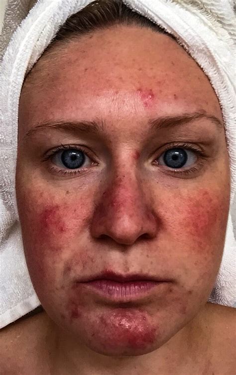 woman diagnosed with acne actually had rosacea and the medications made it worse until she