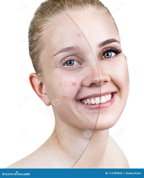 Woman With Acne Before And After Treatment And Make Up Stock Photo