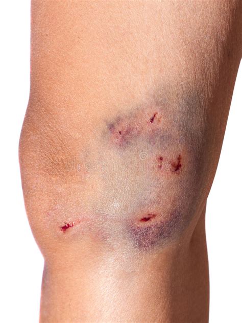 How do i know if my dog bite is infected avid injury and criminal defense law firm infected dog bite stock image c038 1508 science photo library. Bite Wound Blood Bruise Knee Stock Image - Image: 33499745