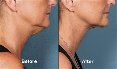 Photos Of Excellent Result Of Multiple Kybella Injection In A Double