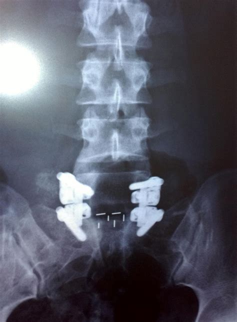 My L5 S1 Spinal Fusion 1st Set Of X Rays Second Post Op Visit W Surgeon And Pictures