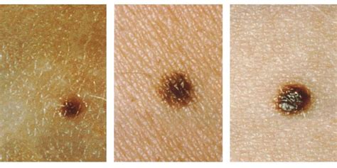How To Check Mole On Skin For Cancer Business Insider