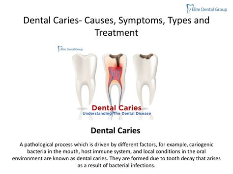 Ppt Dental Caries Causes Symptoms Types And Treatment Powerpoint