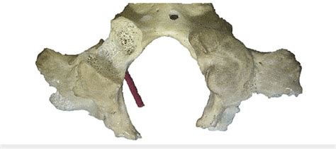 Skull Specimen Where The Right Occipital Condyle Has Been Drilled To