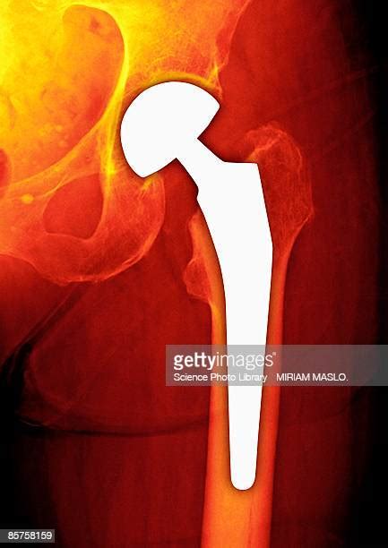 Total Hip Replacement Photos And Premium High Res Pictures Getty Images