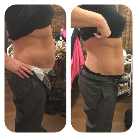 Inches Lost With Our Sessions Of Laser Lipo Laser Lipo Belly