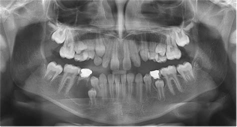 Treatment Of Dentigerous Cysts With A Modified Hawley Plate In Children