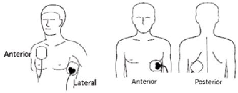 Simply, they go on the front (anterior) of the chest, one above the right nipple. Automated External Defibrillator. 11 | Download Scientific ...
