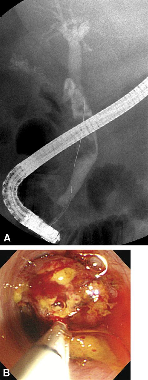 Clinical Feasibility Of Direct Peroral Cholangioscopyguided