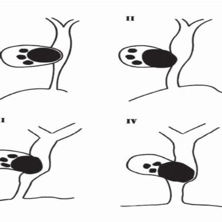 Schematic Representation Of Csendes Classification For Mirizzi Syndrome