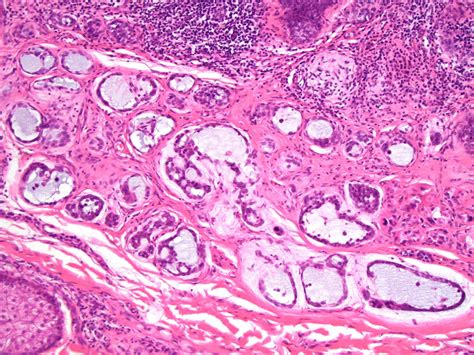 Small Primary Cutaneous Mucinous Carcinoma Mimicking An Early Basal