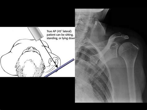 Shoulder Imaging Shoulder And Elbow Orthobullets