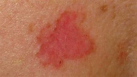 Red Patch On Face Skin Cancer Cancer News Update