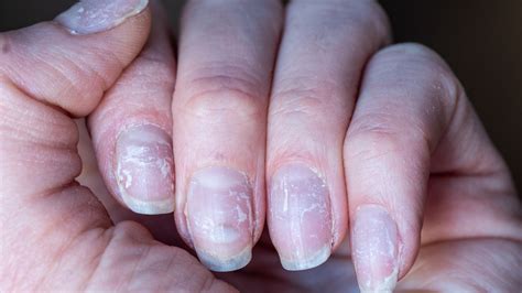 If Youre Nails Are Peeling Heres How You Should Treat Them