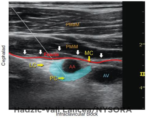 Ultrasound Guided Infraclavicular Brachial Plexus Block Nysora The