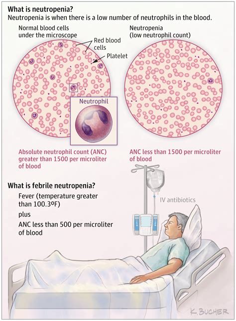 Febrile Neutropenia Oncology Jama Oncology Jama Network