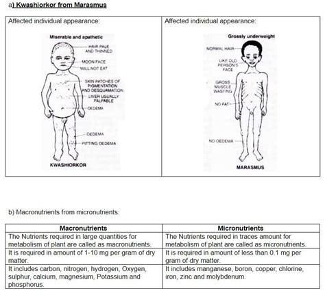Images Of Kwashiorkor Disease In Cartoon