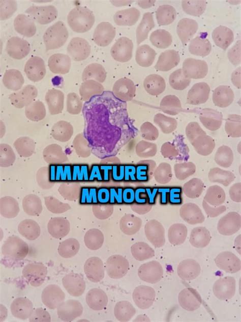 Immature Monocytes Are Significant For Clinical Lab Scientists To Find