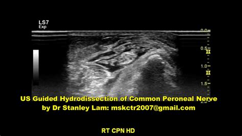 Ultrasound Guided Hydrodissection Of Common Peroneal Nerve Youtube