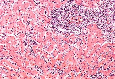 Treat Signs Of Acute Promyelocytic Leukemia With Urgency