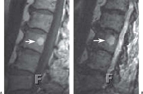 Tumors Of The Spine Radiology Key