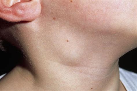 ganglions lymphatiques enflés dans le cou de l enfant causes et traitement