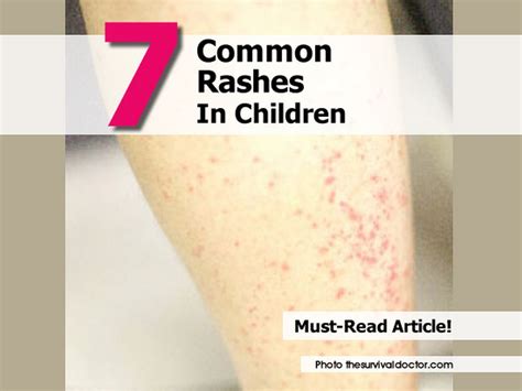 7 Common Rashes In Children