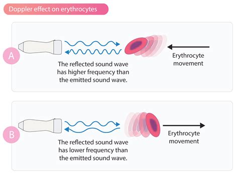 Doppler Effect And Doppler Echocardiography Ecg And Echo