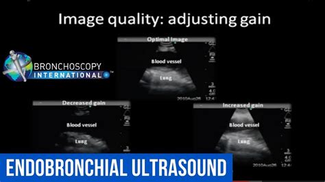 Ebus Physics Video Endobronchial Ultrasound Youtube
