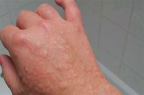 A Quick Overview Of Cold Urticaria Symptoms And Treat
