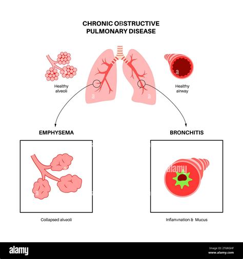 Chronic Obstructive Pulmonary Disease Illustration Stock Photo Alamy