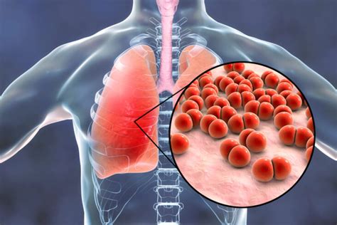 Zapalenie płuc objawy leczenie porady Allergo med Poradnia