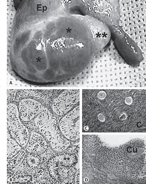 Figure From True Hermaphroditism In A Phenotypic Male Without Ambiguous Genitalia An Unusual