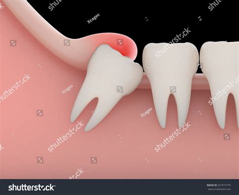 Problems Caused By Impacted Wisdom Teeth Includeinfectionrendering