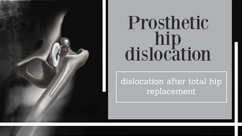 Prosthetic Hip Dislocation Dislocation After Total Hip Replacement