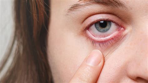 Suffering From Itchy Eyes Know Symptoms And Treatment India Tv
