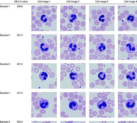 Images Of Neutrophil Blood Smear With Different Neu X Levels Download