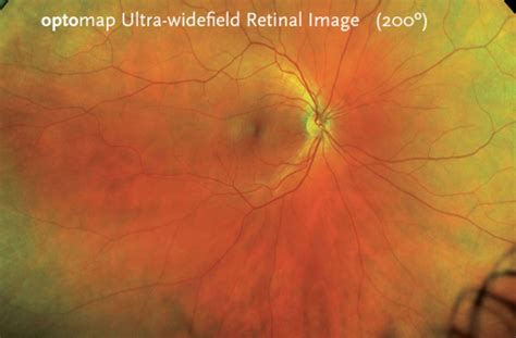 Ultra Widefield Retinal Imaging Noosa Optical Noosa Junction