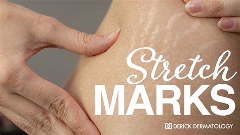 How To Get Rid Of Stretch Marks Derick Dermatology